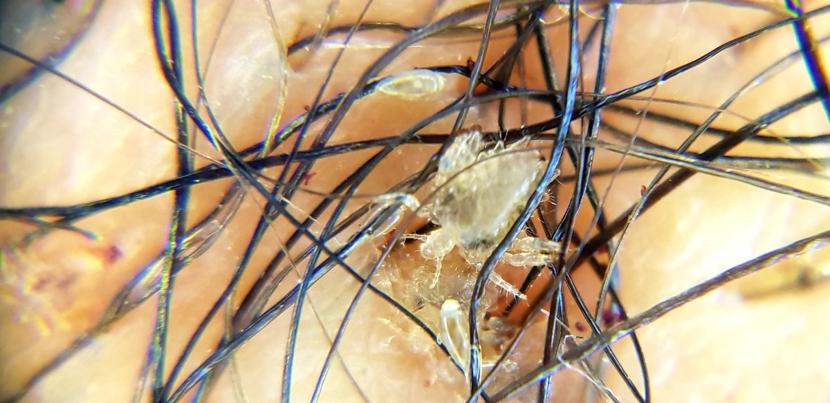 Pubic lice going extinct due to loss of habitat RÚV.is